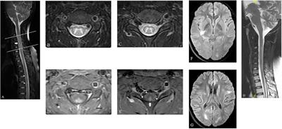 MOG-antibody-associated transverse myelitis with the H-sign and unusual MRI enhancement: a case report and literature review